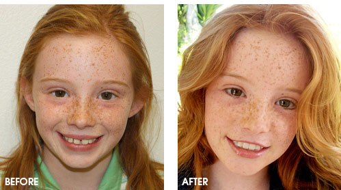 Orthodontics Before and After Photos